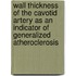 Wall thickness of the cavotid artery as an indicator of generalized atheroclerosis