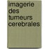 Imagerie des tumeurs cerebrales