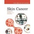 Skin Cancer