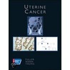 Uterine Cancer by Bluestone