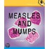 Measles and Mumps