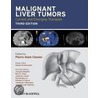 Malignant Liver Tumors door Stefan Breitenstein