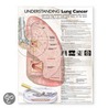 Understanding Lung Cancer Anatomical Chart door Onbekend