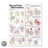 Hip and Knee Inflammations Anatomical Chart by Anatomical Chart Company