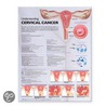 Understanding Cervical Cancer Anatomical Chart by Anatomical Chart Company