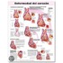 Heart Disease Anatomical Chart in Spanish (Enfermedad Cardiaca)