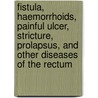 Fistula, Haemorrhoids, Painful Ulcer, Stricture, Prolapsus, And Other Diseases Of The Rectum door William Allingiham