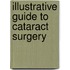 Illustrative Guide To Cataract Surgery