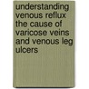 Understanding Venous Reflux The Cause Of Varicose Veins And Venous Leg Ulcers by Mark S. Whiteley