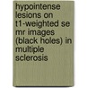 Hypointense Lesions On T1-weighted Se Mr Images (black Holes) In Multiple Sclerosis door M.A.A. van Walderveen