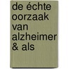 De échte oorzaak van Alzheimer & ALS door Edith Borghuis