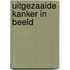 Uitgezaaide kanker in beeld